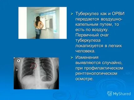 Насколько заразен туберкулез