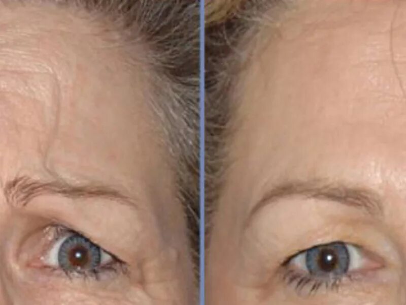 Ботокс в глаза до и после отзывы Botox For Forehead Lines LK Aesthetics 1000x773 jpeg Botox stirn, Botox, P