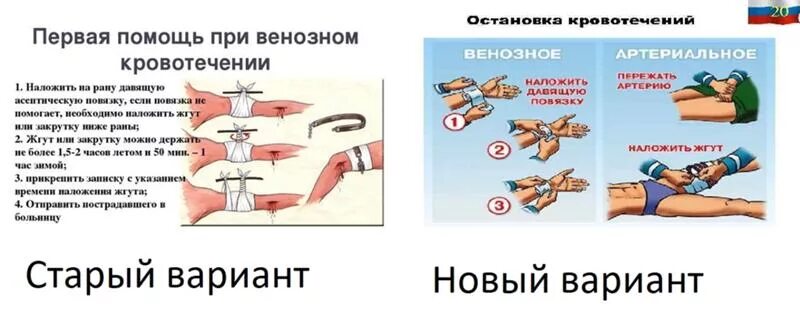 Наложение жгута при венозном кровотечении. При венозном кровотечении жгут накладывается. Венозноеное кровотечение наложение жгута. Места наложения кровоостанавливающего жгута.