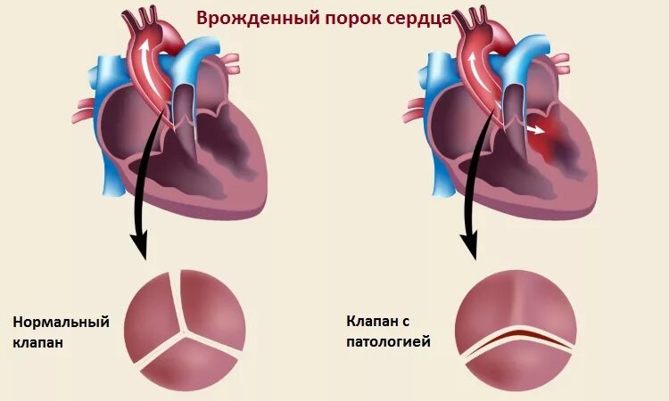 Врожденные пороки сердца ВПС У детей. Как выглядит порок сердца. Что такое враждебный порог сердца.