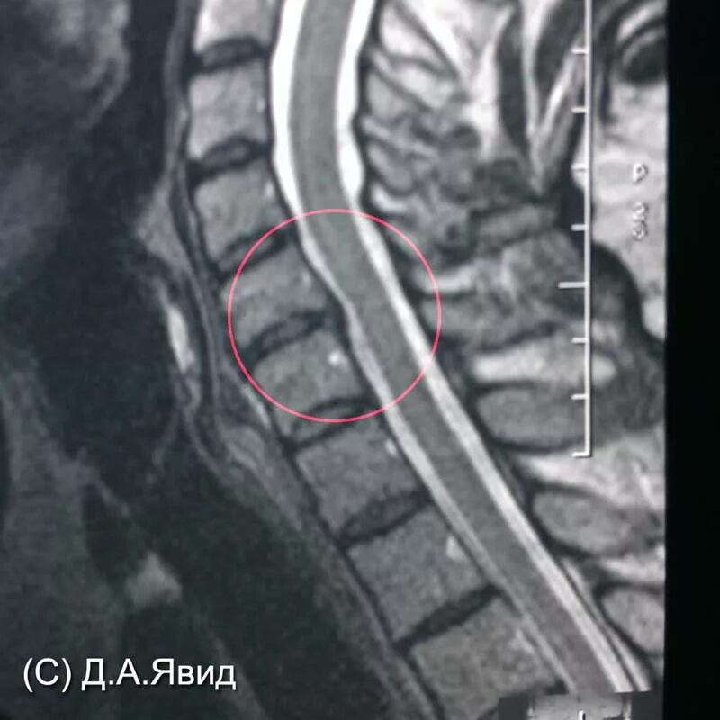 Медианная секвестрирующая грыжа. Секвестрированная грыжа позвонка. Межпозвоночная грыжа поясничного отдела мрт. Грыжа шейного отдела позвоночника мрт. Шейная грыжа лечение без операции