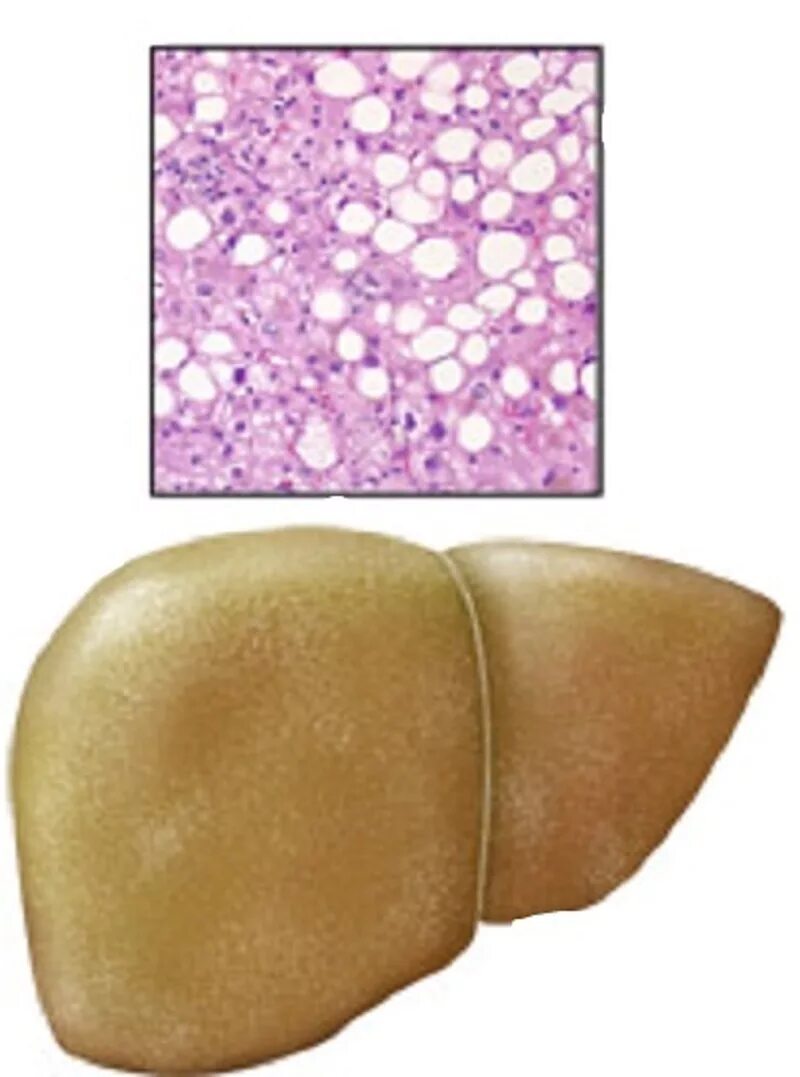 Желчный ожирение. Жировая дистрофия печени(жировой гепатоз). Гепатоз ожирение печени. Острый гепатоз печени патанатомия. Тиреотоксический гепатоз.