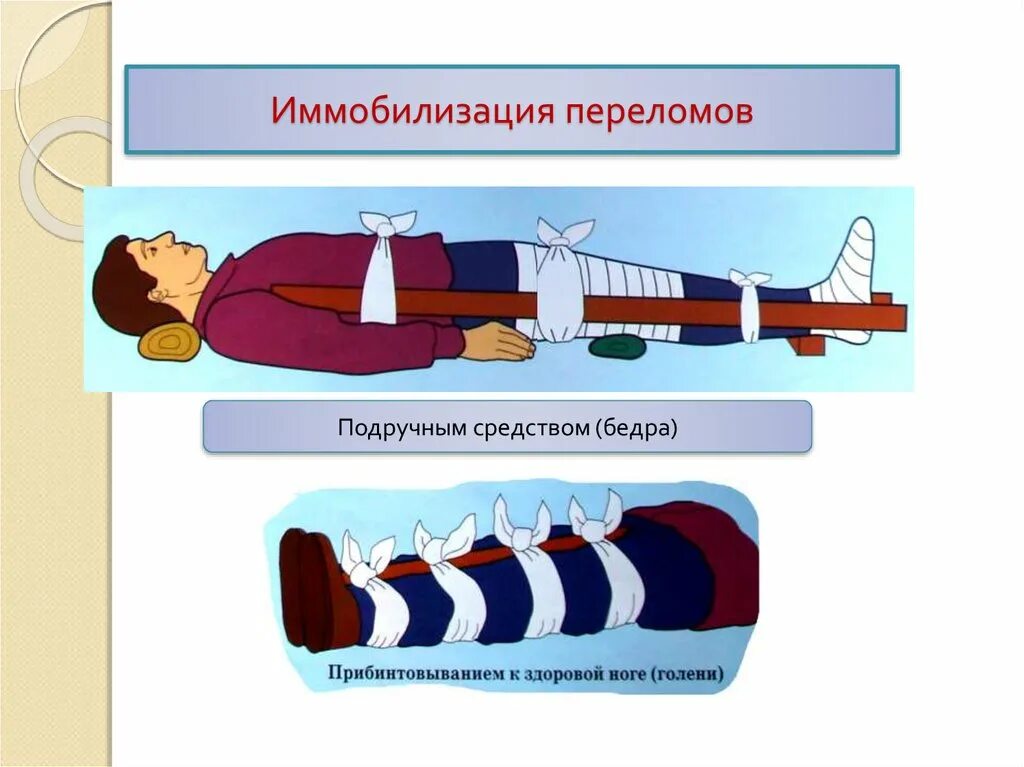 Помощь при открытом переломе бедра. Иммобилизация конечности при открытом переломе. Иммобилизация при переломе ноги. Иммобилизация при переломе костей голени. Транспортная шина при переломе.