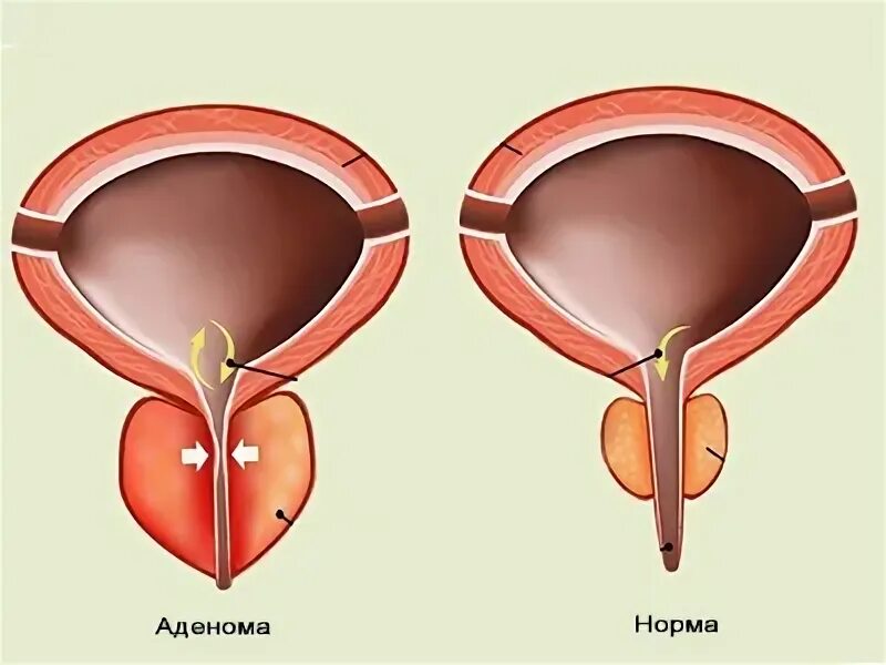 Простатит гиперплазия. Энуклеация аденомы предстательной железы. Аденома простаты клиника. Стимуляция уретры у мужчин. Аденома простаты бандаж.