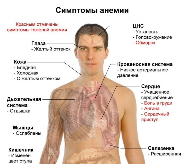 Спорт при анемии. Дефицит железа симптомы.