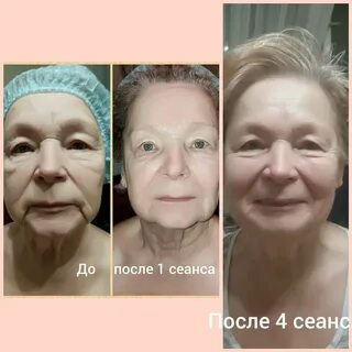 Скульптурный массаж до и после