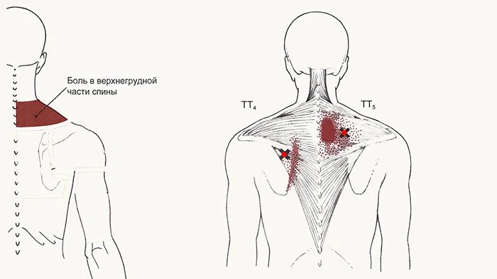 Болит спина с правой стороны лопатки. Триггерные точки на ключице. Триггерные точки верхняя часть спины. Многораздельная мышца спины триггерные точки. Триггерные точки в области ключицы.