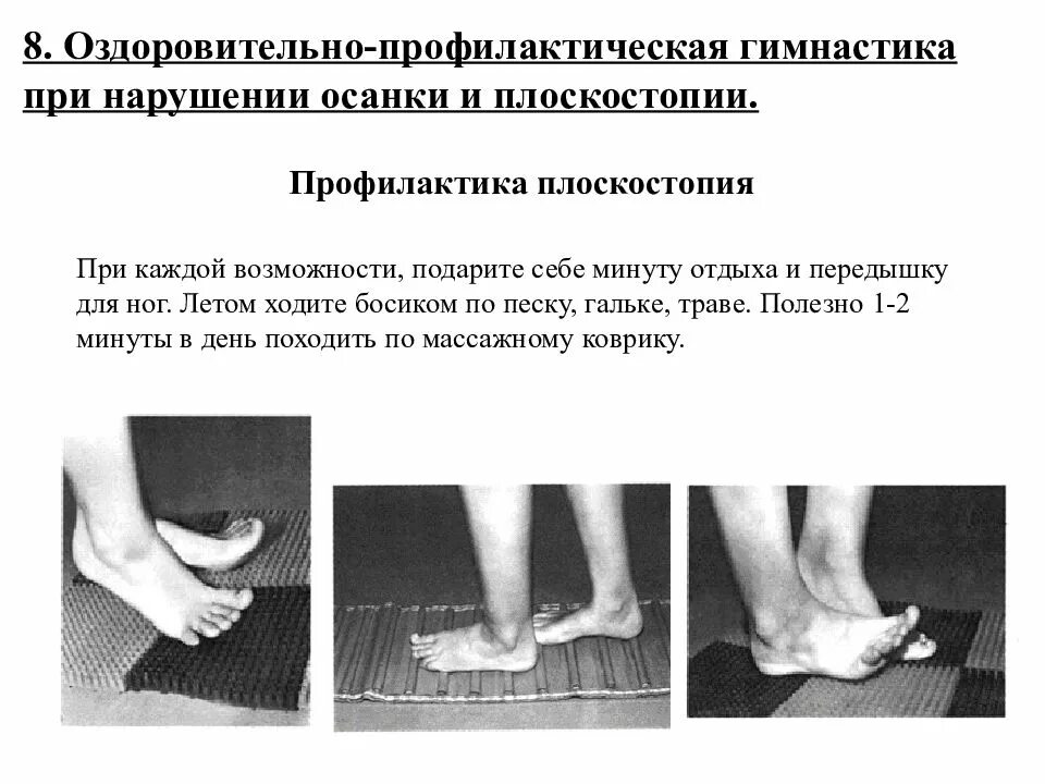 Как исправить плоскостопие