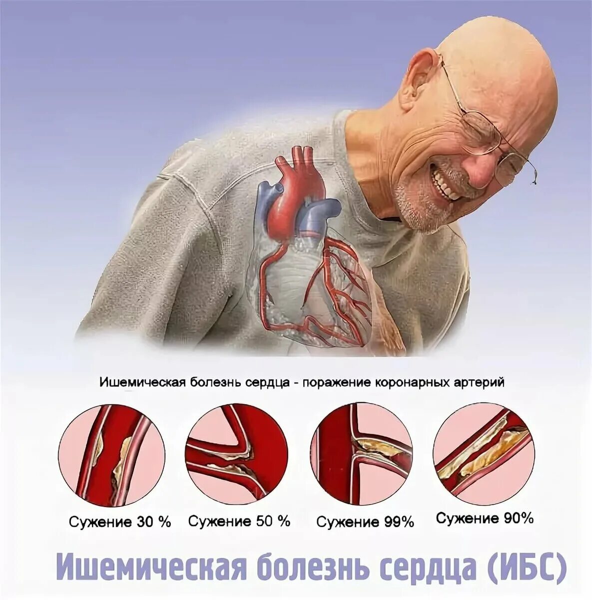 Ишемия сосудов симптомы. Ишемическая болезнь сердца. Коронарная ишемия сердца. Ишемическая болезнь сердца заболевания. Семемической болезни сердца.