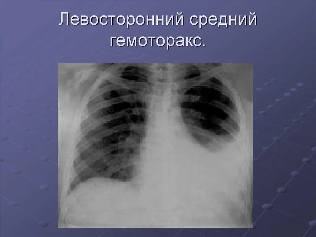 Гемоторакс симптомы. Гемоторакс и пневмоторакс рентген. Левосторонний большой гемоторакс. Травматический гемоторакс. Гемоторакс симптомы.