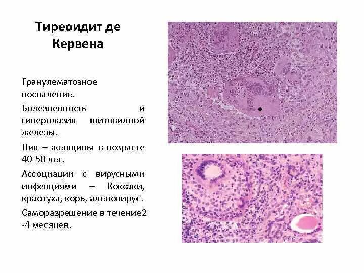 Гиперплазия щитовидной железы что это такое. Тиреоидита Хашимото гистология. Аутоиммунный тиреоидит зоб Хашимото микропрепарат. Подострый тиреоидит гистология. Аутоиммунный тиреоидит Хашимото микропрепарат патанатомия.