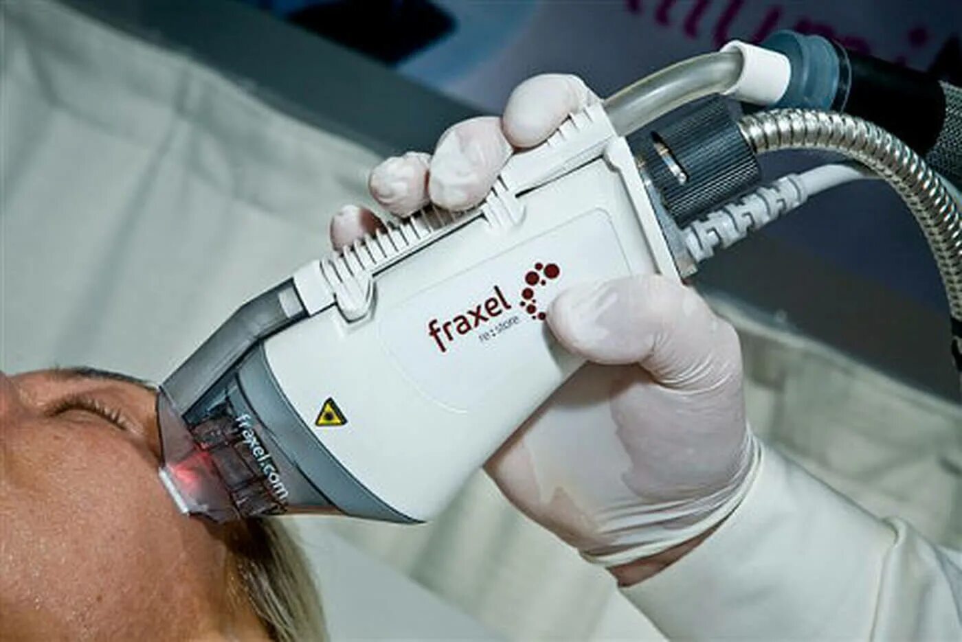 Dot лазер. Fraxel sr1500. фраксель лазерное омоложение. фракционный абляционный лазер co2. фракционный фототермолиз со2.