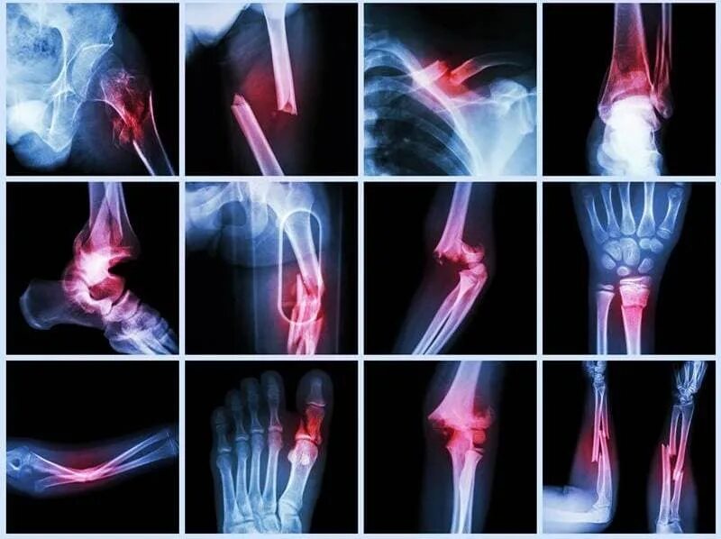 Перелом кости может быть каким. Рентгенограмма перелом кости. Травматология кости переломы. Перелом (Fracture), 2007. Рентгеновские снимки переломов.