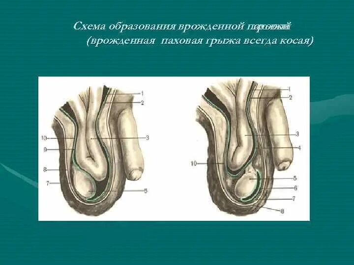 Паховая грыжа у ребенка отзывы. Врожденная паховая грыжа схема. врожденная пахово мошоночная грыжа. причины образования паховых грыж у детей.