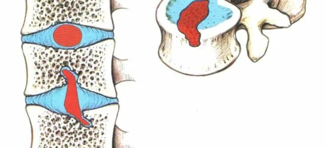 Протрузии шморля. Грыжа шморля поясничного отдела позвоночника что это. губчатая грыжа шморля l4. грыжи шморля th5-th12. шморля в грудном отделе позвоночника.