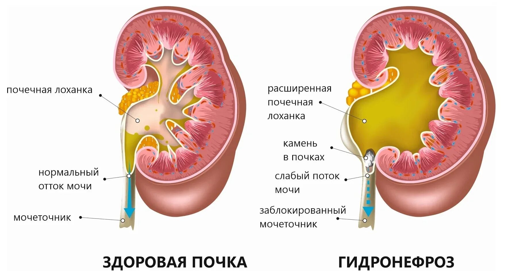 Как лечить гидронефроз почки. Как лечить гидронефроз почки