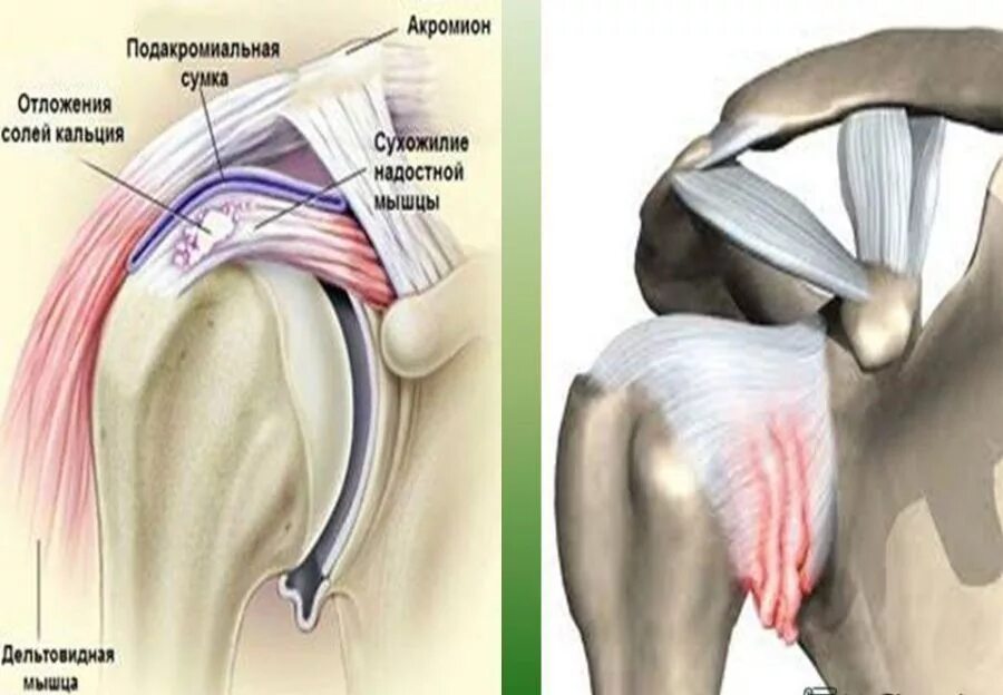 Плечевой периартрит что это. Лопаточный периартроз плечевого сустава. Периартроз плечевого сустава симптомы. Суставной капсулит плечевого сустава. Плечевой капсулит симптомы.