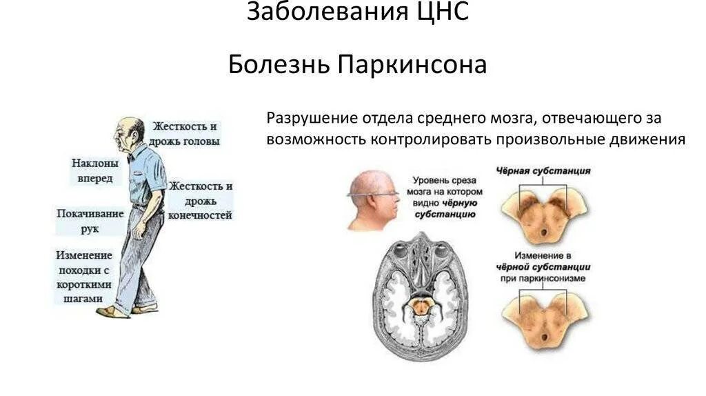 Болезнь заболевание мозга. Поражение структур мозга при болезни Паркинсона. Отделы поражения мозга при болезни Паркинсона. Хронические заболевания ЦНС список. При болезни Паркинсона поражается структура мозга:.