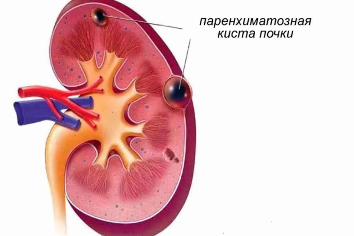 Киста в почке лечение у взрослых женщин. Парапельвикальная киста. Перипельвикальные кисты почек на кт. Парапельвикальнвя киста повки. Парапельвикальная киста почки.