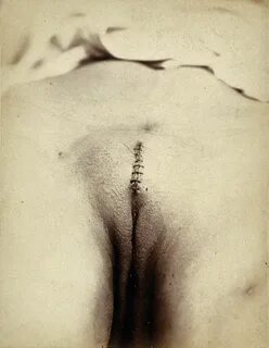 Cosmetic surgery in progress: a woman's pubes, showing a sutured incis...