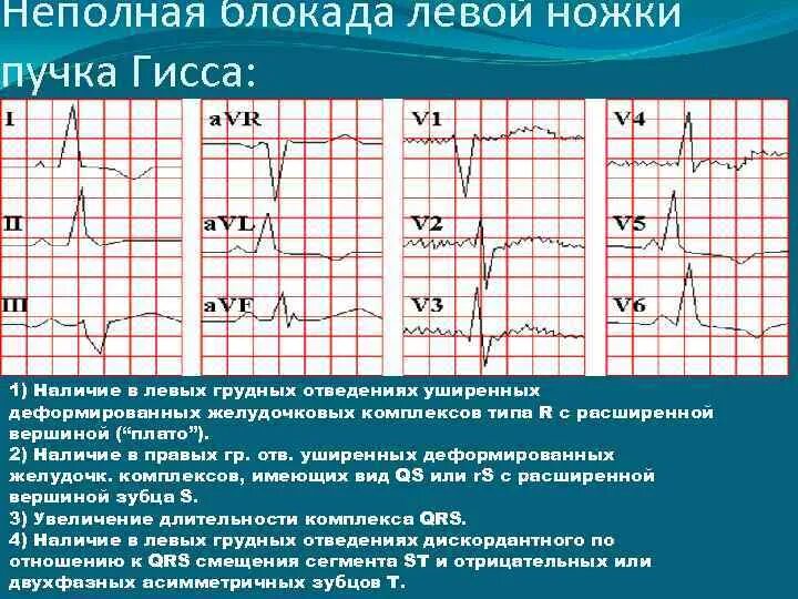 Опасна ли неполная блокада. Неполная блокада левой ножки пучка Гиса на ЭКГ. Блокада ПНПГ на ЭКГ. Неполная блокада ножки Гиса на ЭКГ. Неполная блокада ЛНПГ на ЭКГ.