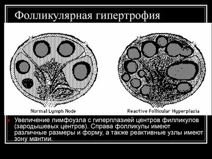 Гиперплазия 1 степени