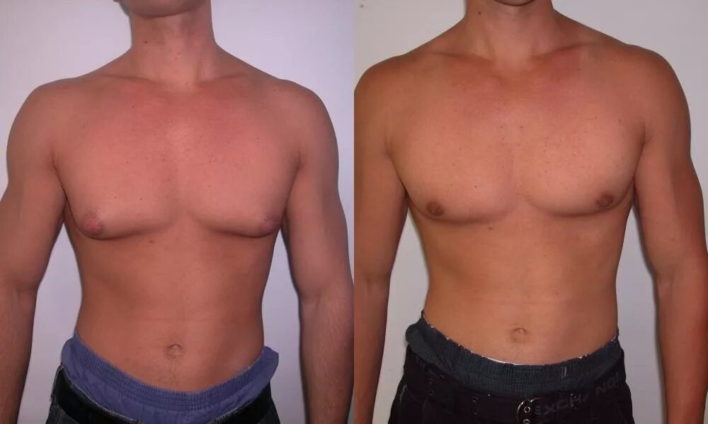 Гинекомастия клайнфельтера. Уменьшение молочных. Уменьшение молочных. Уменьшение молочных. Уменьшение молочных.