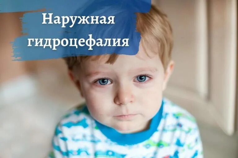 Гидроцефалия головного мозга у ребенка что это. Гидроцефалия головного мозга. гидроцефалия статистика по россии. дизартрия у детей с гидроцефалией.