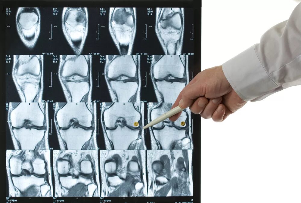 Повреждение мениска коленного сустава мрт. Снимок мрт коленного сустава с разрывом мениска. Мрт снимки поврежденного мениска. Разрыв мениска мрт снимки.