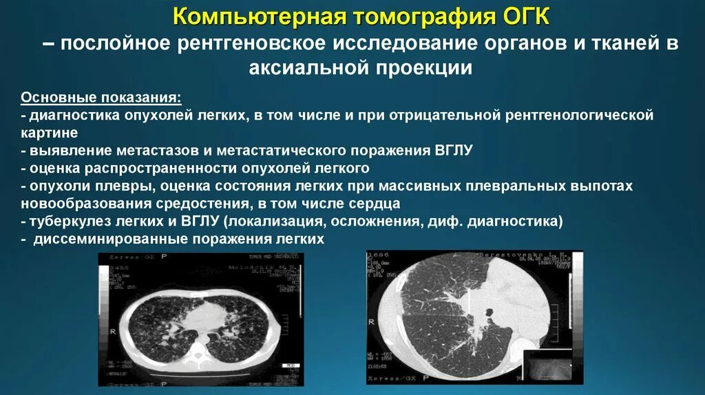Можно ли кт. Рентгеновская томография органов грудной клетки. Компьютерная томография ОГК. Исследование кт легких. Проекции компьютерной томографии.