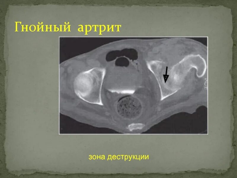 Зона деструкции
