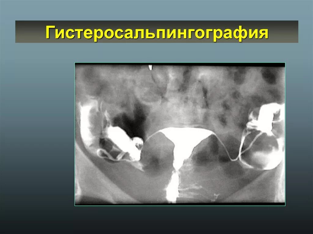 Эхо трубы. Метод диагностики проходимости маточных труб. ГСГ обследование маточных труб. Рентгенологическая оценка проходимости маточных труб. Методы исследования проходимости маточных труб.