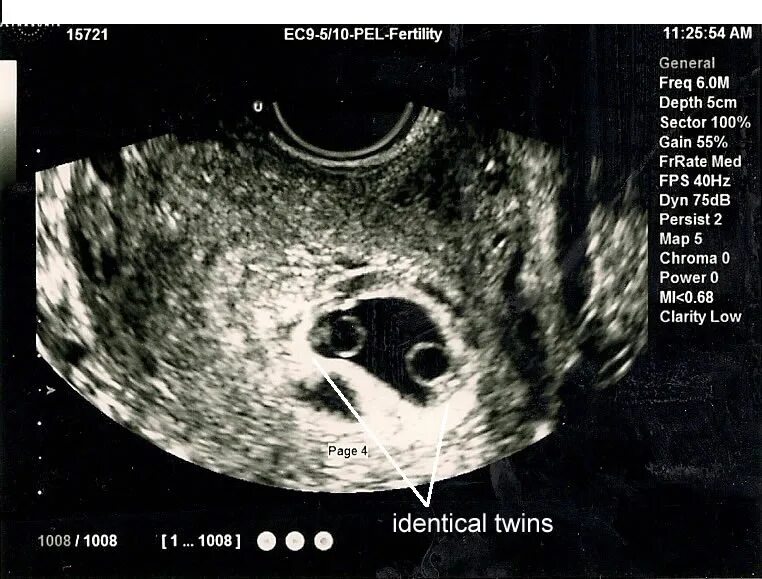 Многоплодная беременность УЗИ 6 недель. УЗИ 6 недель беременности двойня однояйцевые. Однояйцевая двойня на УЗИ 6 недель. УЗИ 7 недель беременности двойня. 6 недель учиться