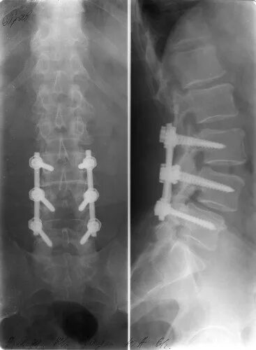 Транспедикулярный остеосинтез. Транспедикулярная система позвоночника. Транспедикулярный остеосинтез позвоночника. Остеосинтез поясничного отдела позвоночника. Операция на позвоночник с металлоконструкцией инвалидность