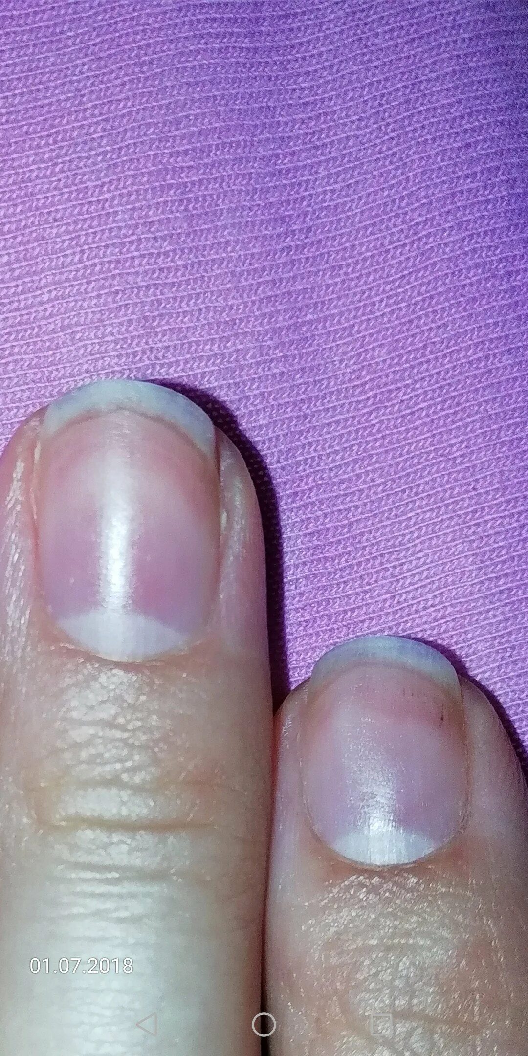 Полоски на ногтях причины вертикальные у женщин. Ониходистрофия, лейконихия. Лейконихия продольная. Ониходистрофия (дистрофия ногтей). Продольные полосы на ногтях.