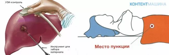 Температура после пункции. Тонкоигольная аспирационная пункционная биопсия. Тонкоигольная биопсия печени. Чрескожная трепан биопсия печени.