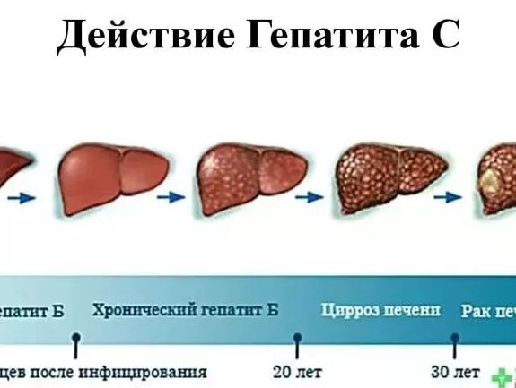 Стадии гепатита печени