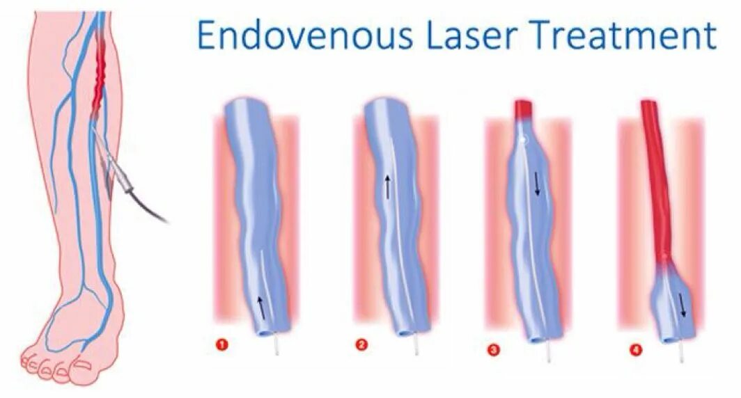 Варикоз вен лазерная коагуляция. Лазерная коагуляция вены. Удаление тромба цена