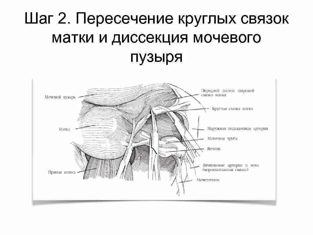 Круглая связка матки. Болит круглая связка матки. Круглая связка матки располагается. Где находятся круглые связки