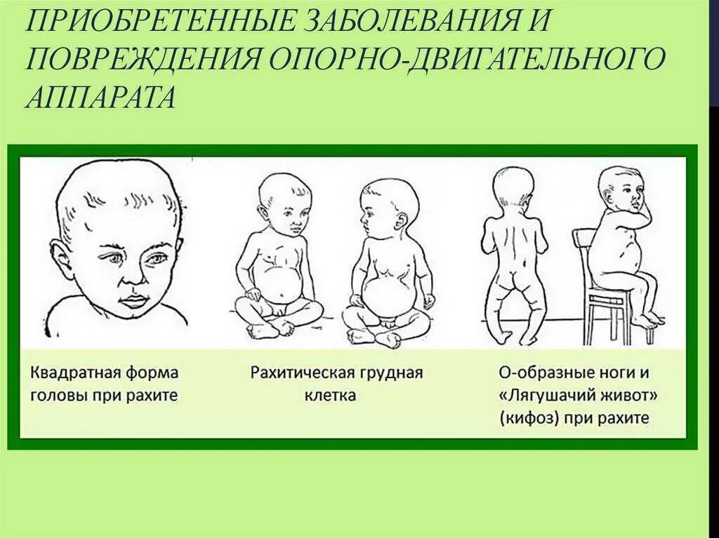 Грудная клетка рахит 2 года. Рахит 2 степени у грудничка признаки. Рахит 1 степени симптомы у новорожденных. Форма головы при рахите у грудничка. Признаки рахита 1 год