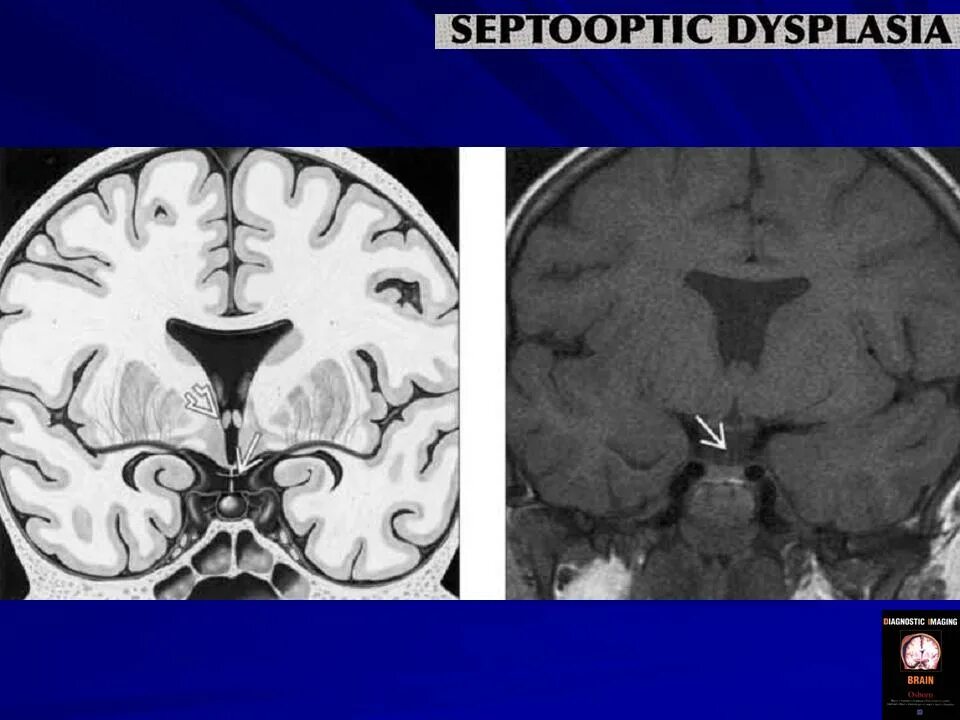Трансмантийная кортикальная дисплазия. Кистозная церебральная дисплазия. Дисплазия мозга у детей. Аномалии развития головного мозга мрт. Фкд головного мозга мрт.