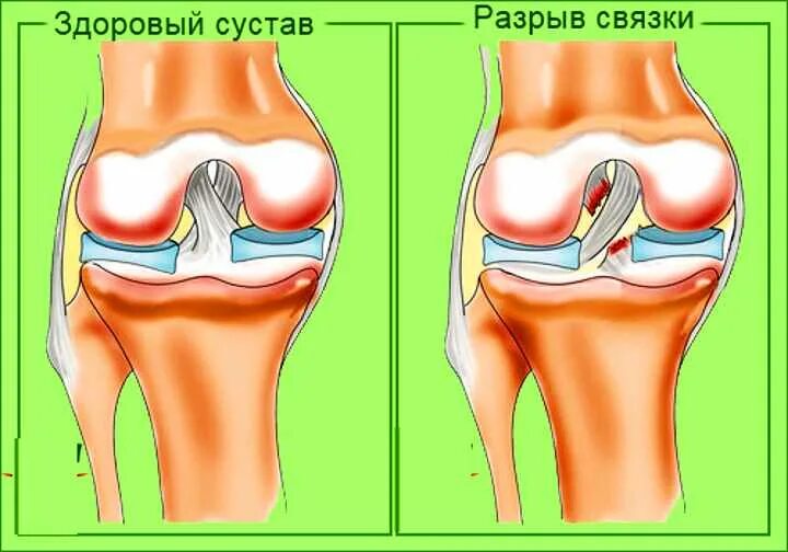 При разрыве связок коленного сустава. Повреждение медиального мениска зкс. Медиальный эпикондилит коленного сустава. Разрыв сухожилия бедра. Эпикондилит коленного сустава.