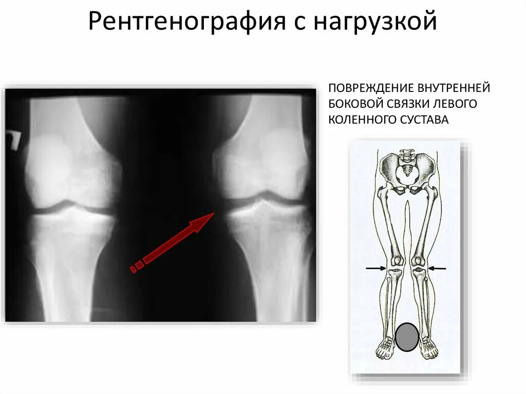 Повреждение латерального