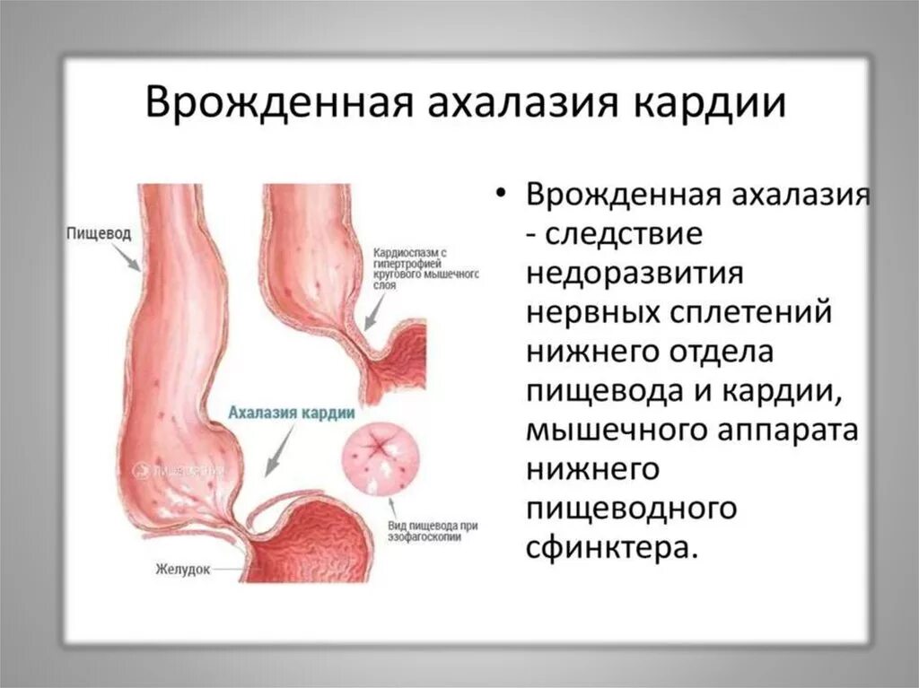 Пищевода клинические рекомендации. Ахалазия кардии это спазм. Симптомы ахалазии кардии. Симптомы ахалазии пищевода. Основной клинический симптом ахалазии кардии.