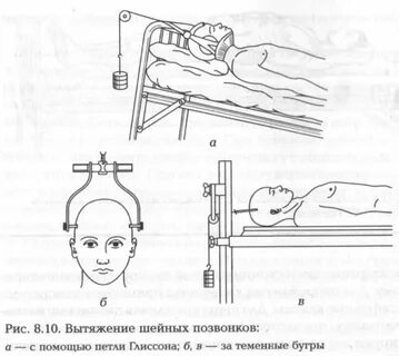 Пациент с переломом позвоночника