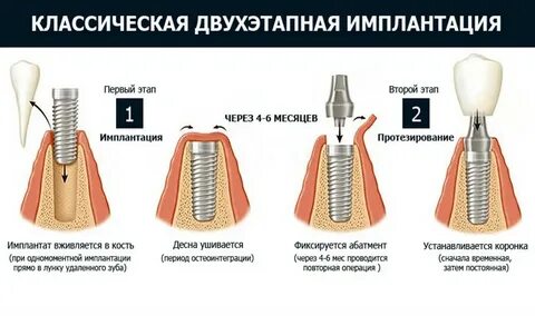 Когда можно есть после импланта