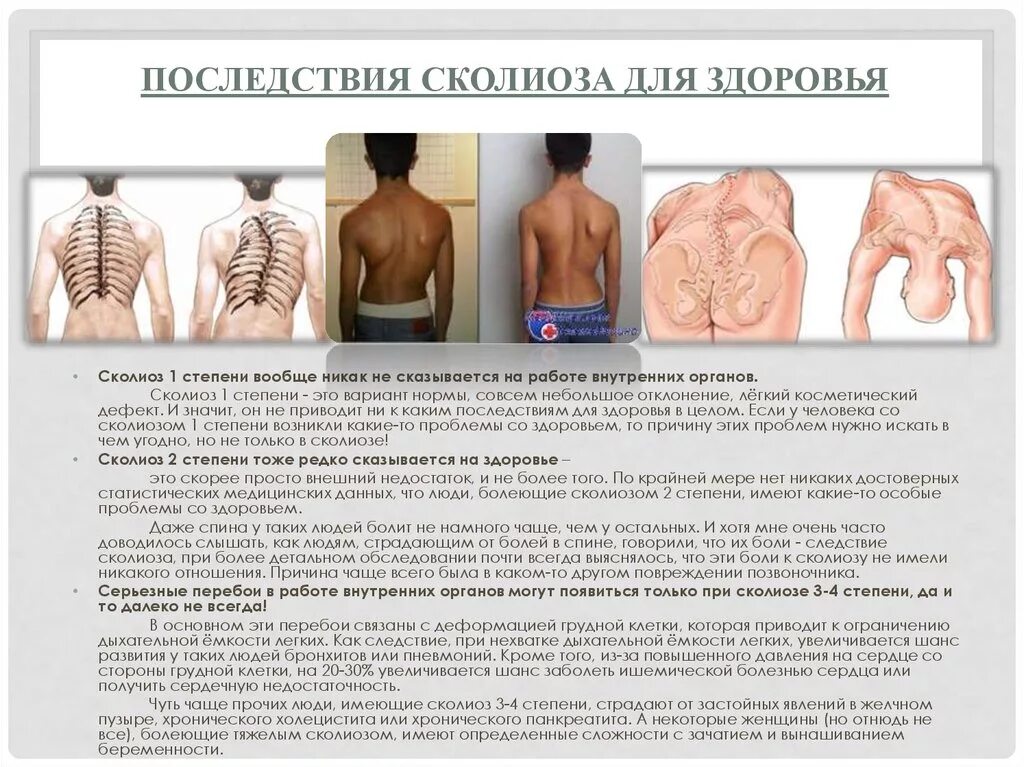 Сколиотическая деформация позвоночника. Сколиоз позвоночника последствия. Осложнения при сколиозе. Сколиоз 2 степени это