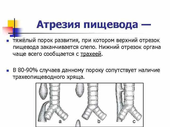 Атрезия пищевода. Атрезия пищевода хирургия. атрезия пищевода клиническая картина. клинические проявления атрезии пищевода.