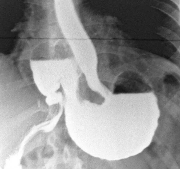 Контрастирование желудка рентген. Рентген исследования желудка и 12 перстной кишки. Рентгенологическое исследование пищевода, желудка, 12-перстной кишки.. Рентгенограмма 12 перстной кишки. Скопия пищевода желудка