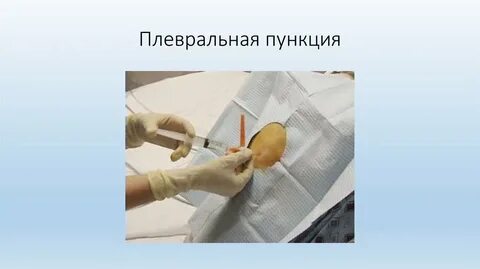 Плевральная пункция
